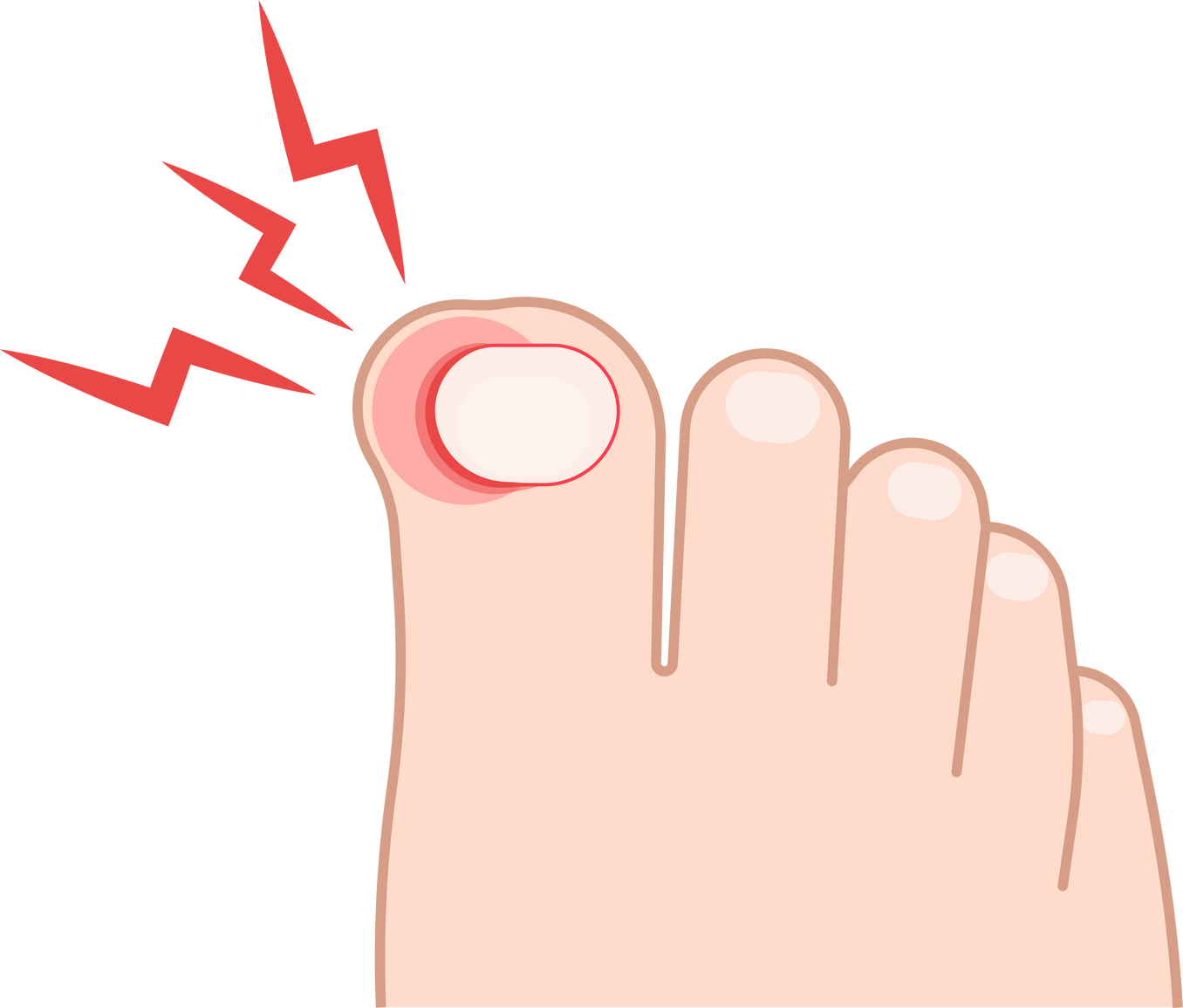 ingrown toenail painful feet inflamed